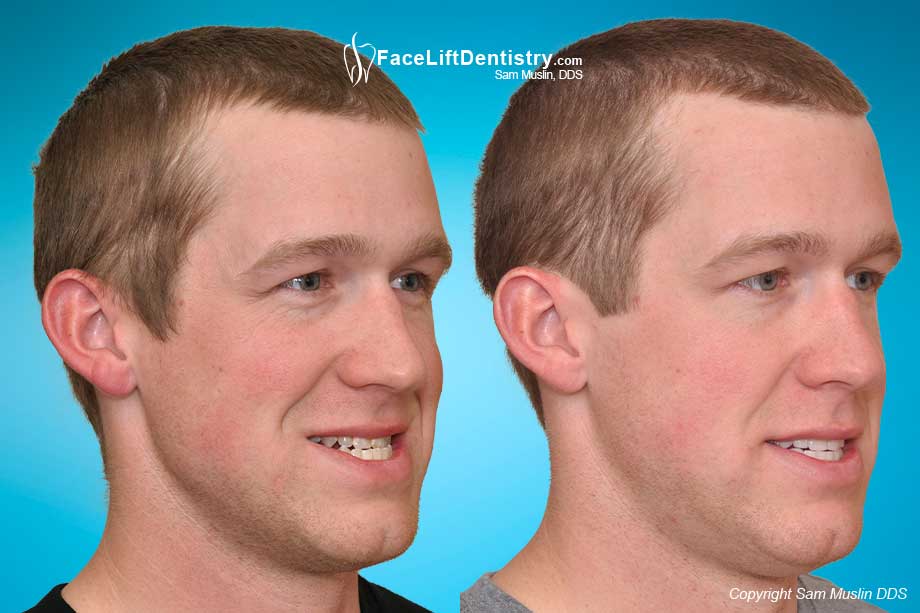 Underbite Before and After: Amazing Changes (What to Expect)