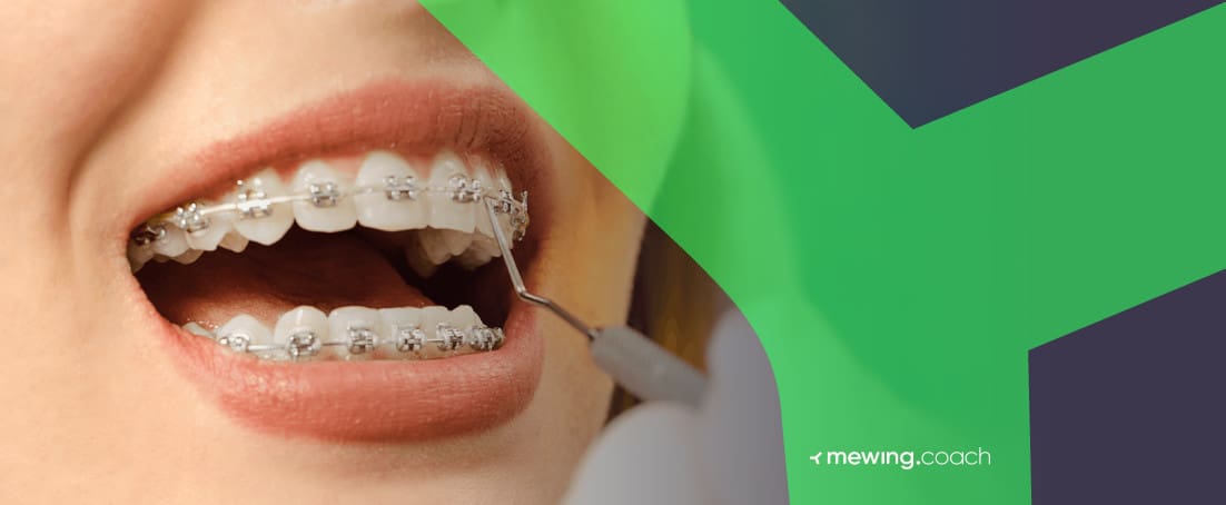 How to choose a jaw brace? Top tips for finding the right jaw brace for your needs