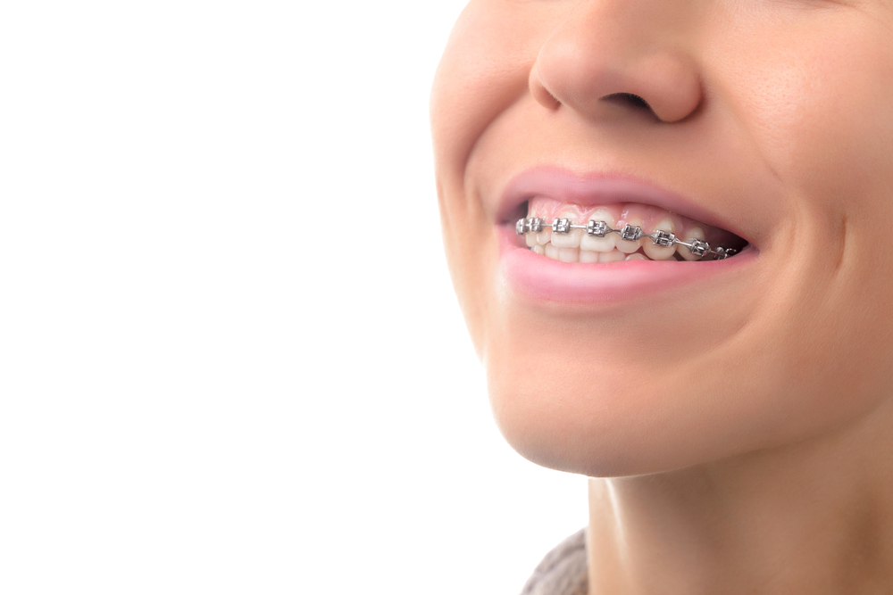 How to choose a jaw brace? Top tips for finding the right jaw brace for your needs