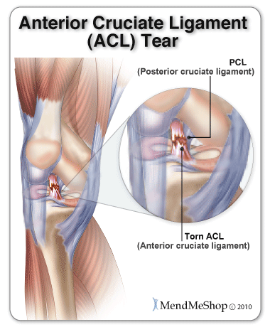 Is a Torn Achilles the Same as a Torn ACL? This Will Help You Understand!