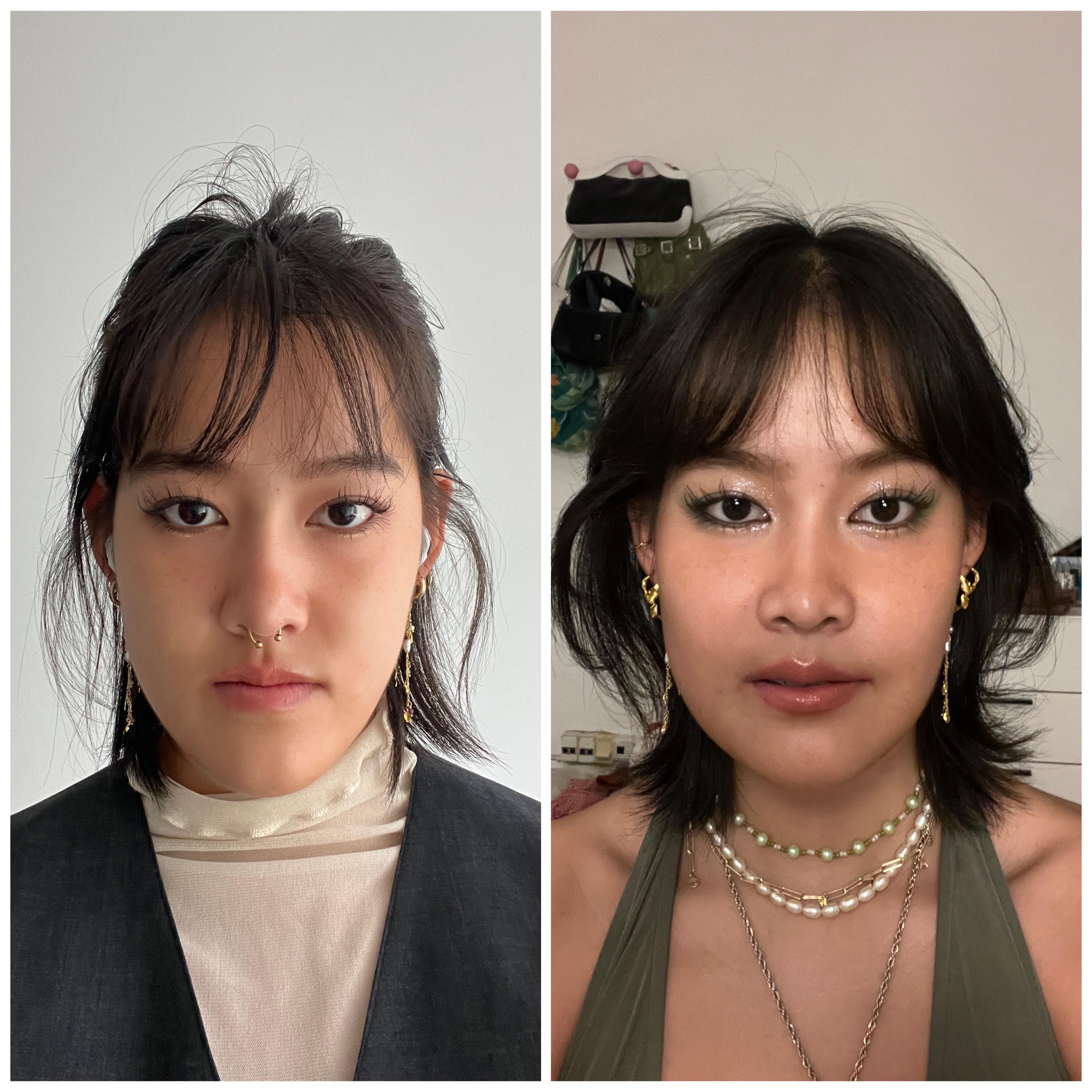 Underbite Before and After: Amazing Changes (What to Expect)