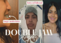 What to Expect: Underbite Jaw Surgery Before and After Journey