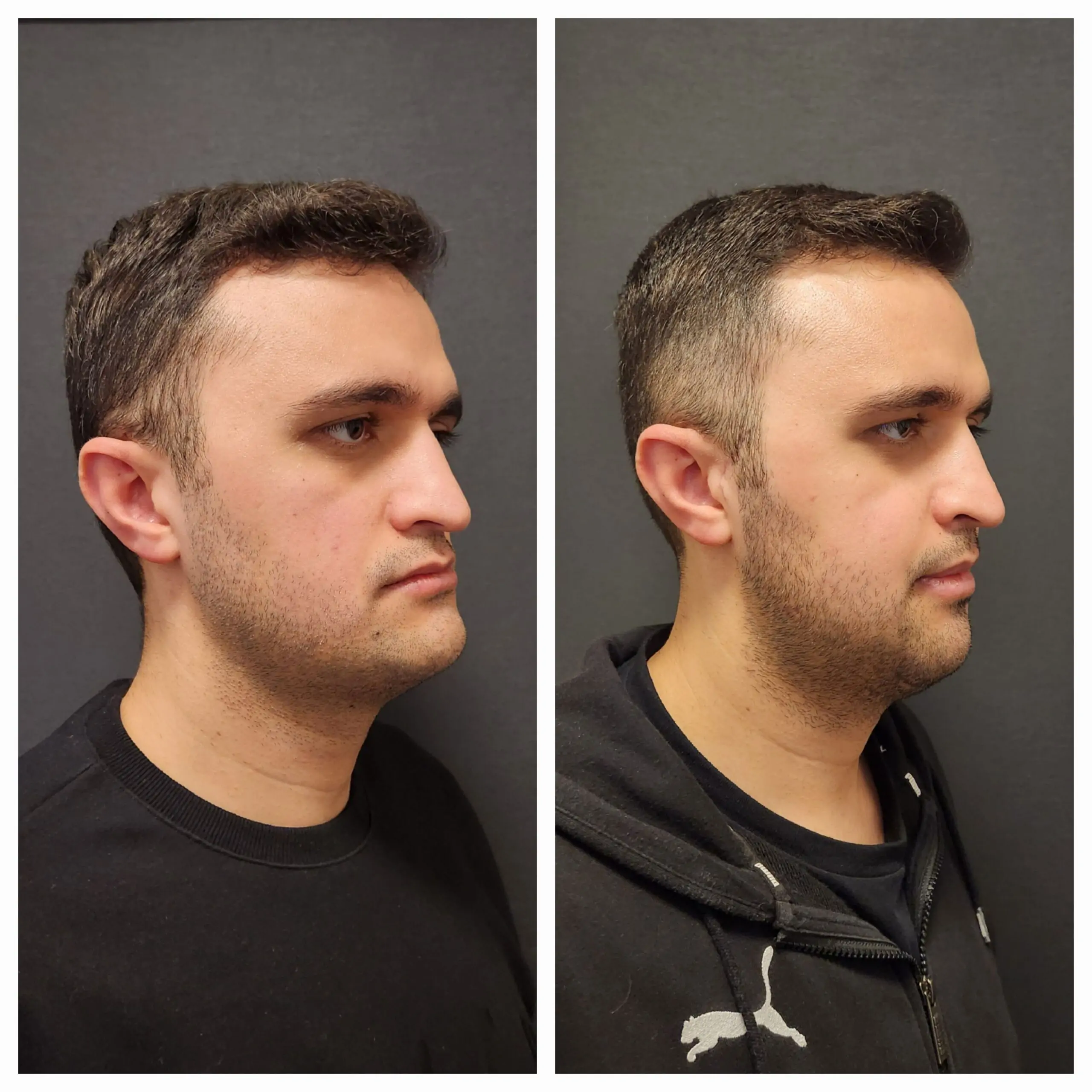 What to Expect: Underbite Jaw Surgery Before and After Journey