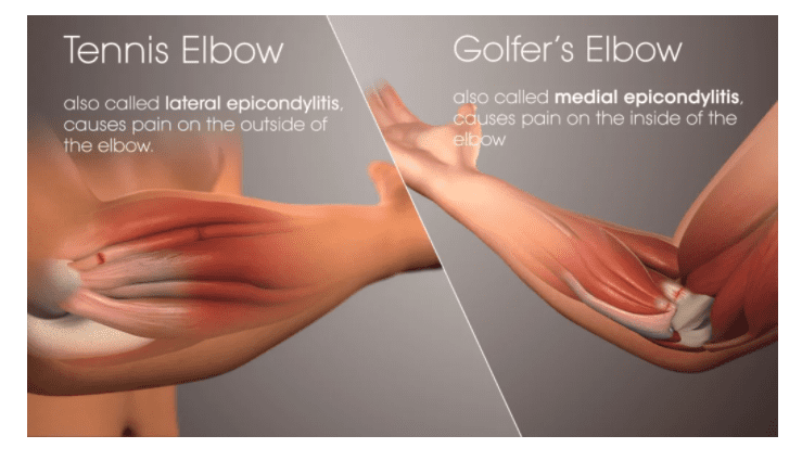 Fighters With Golfers Elbow: A Guide to Pain-Free Training