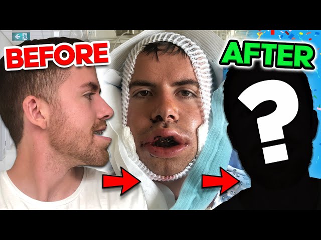 What to Expect: Underbite Jaw Surgery Before and After Journey