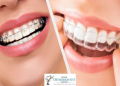Is it worth it? Can you get braces even if your teeth are fine? Understand the non-visual reasons today.