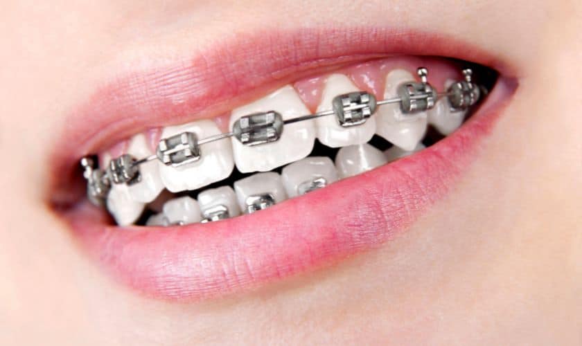 Is it worth it? Can you get braces even if your teeth are fine? Understand the non-visual reasons today.
