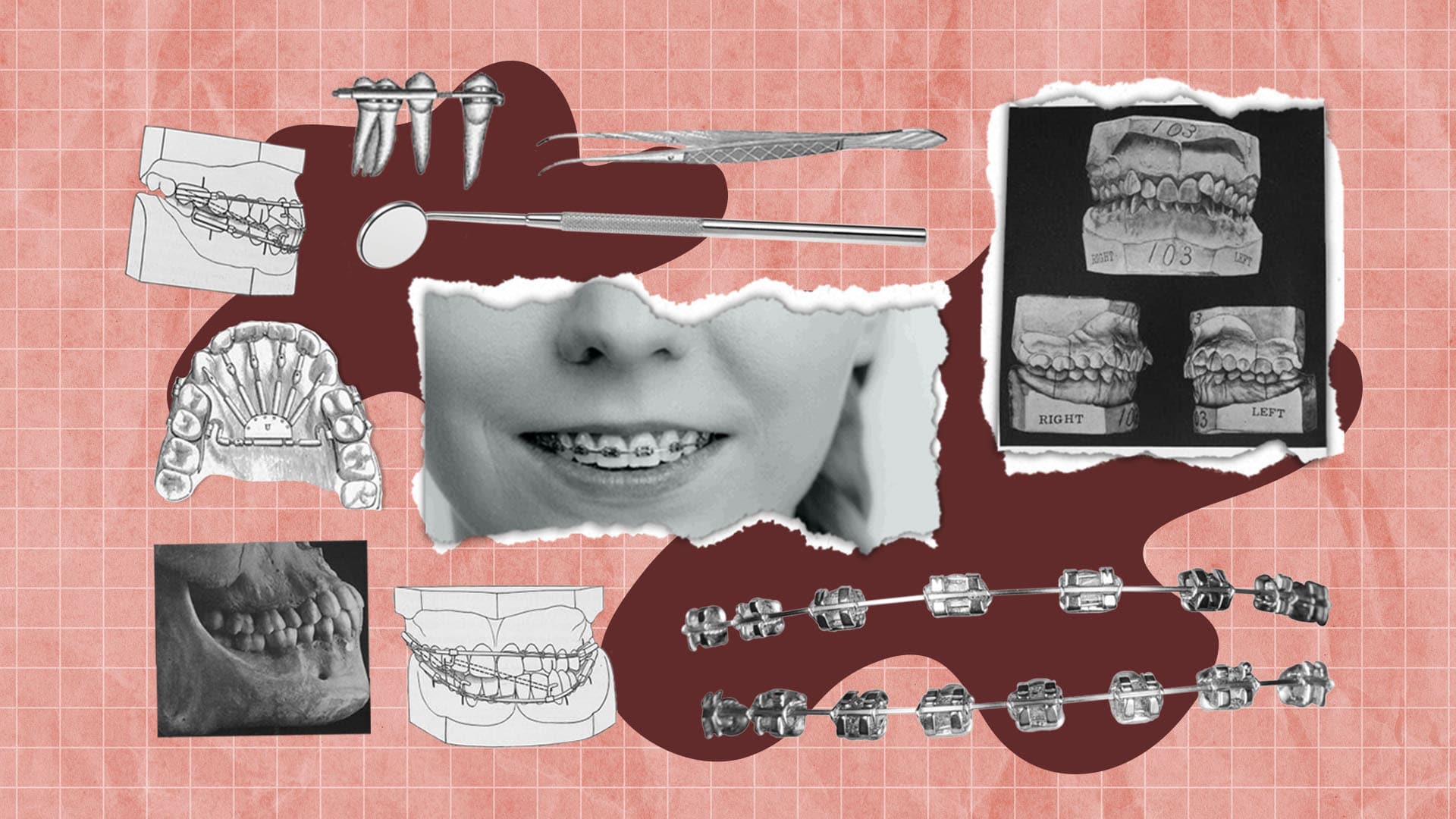 Is it worth it? Can you get braces even if your teeth are fine? Understand the non-visual reasons today.