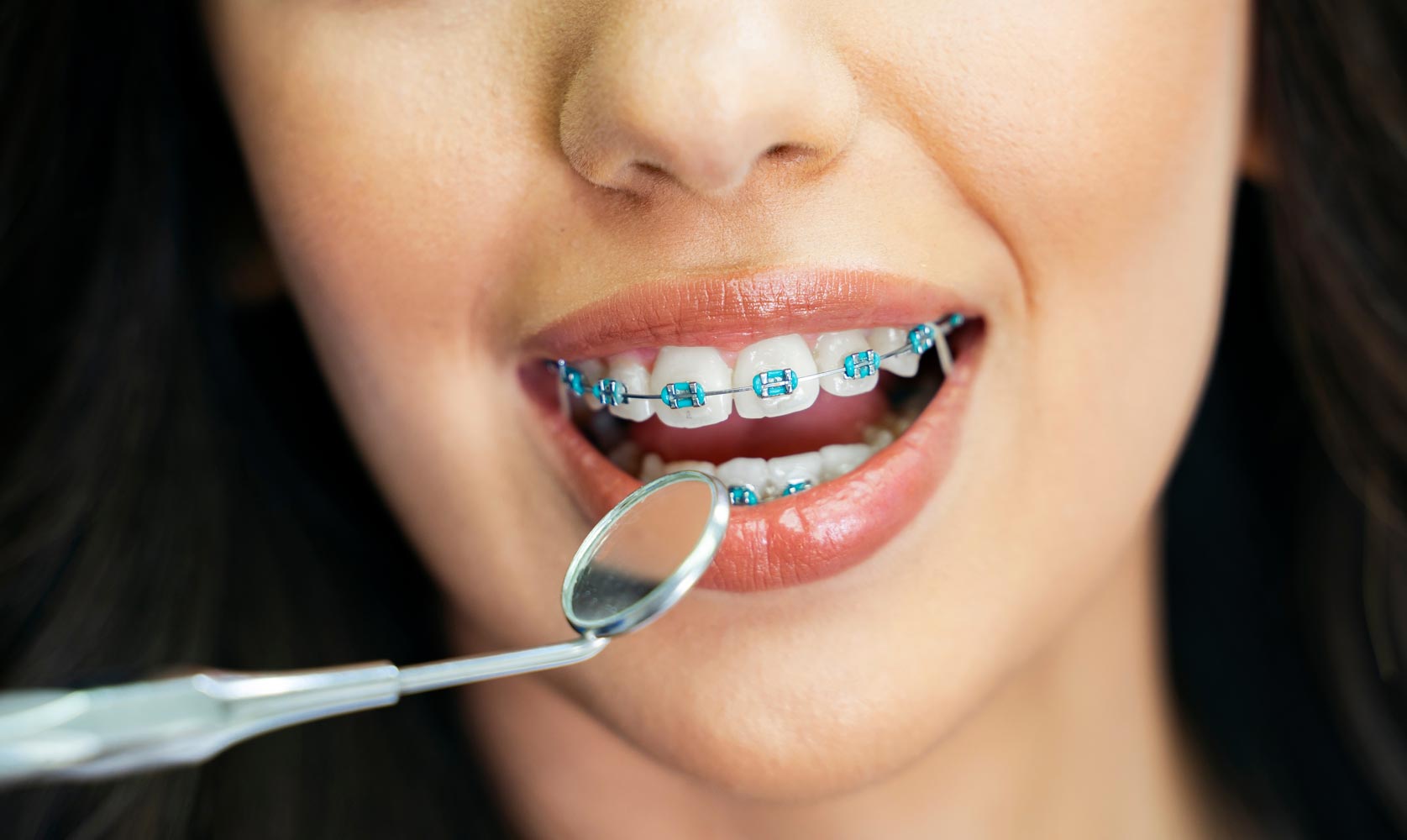 Is it worth it? Can you get braces even if your teeth are fine? Understand the non-visual reasons today.